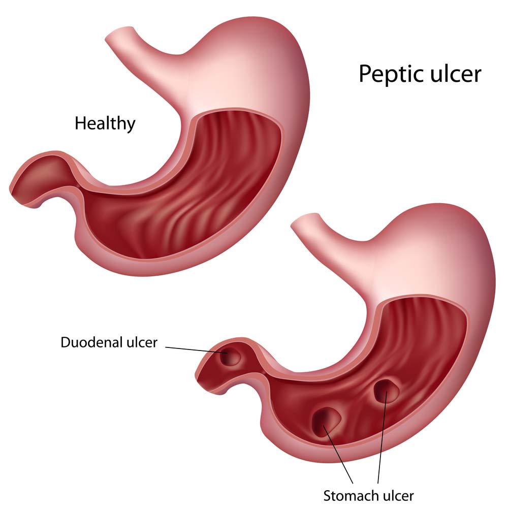 Stomach Ulcer Treatment Med Health