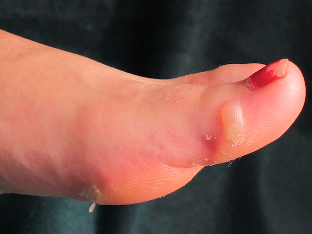 Blisters On Feet Med 6061
