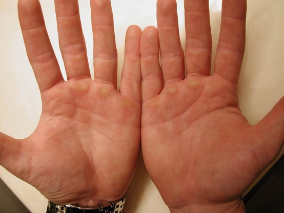 What Causes Lump To Appear In Your Palm Med Health