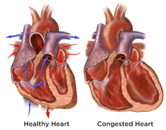 How Long Can You Live With Congestive Heart Failure? | Med ...