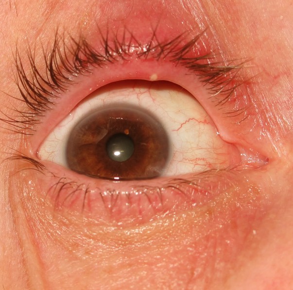 yellow eyeballs under eyelids